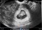 Pemindai Kehamilan Portabel Endocavity Transvaginal Untuk USG Portabel OB / GYN